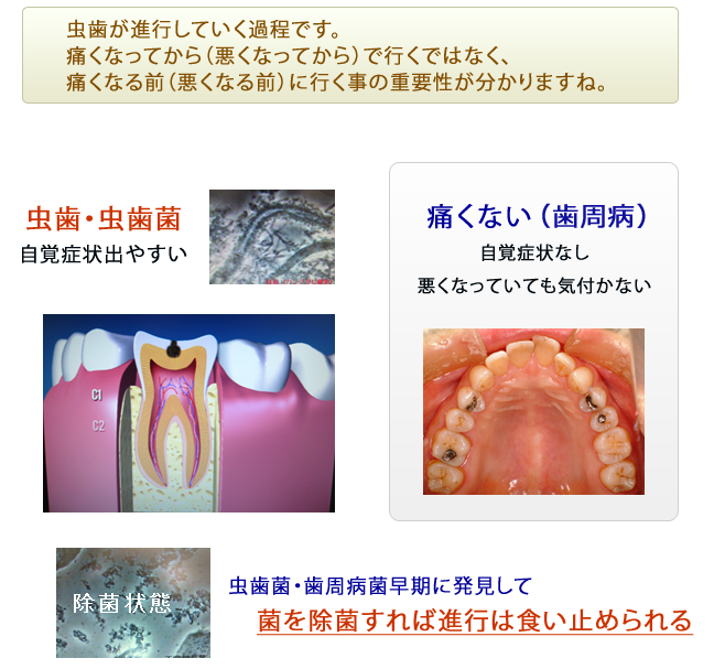 虫歯治療画像１
