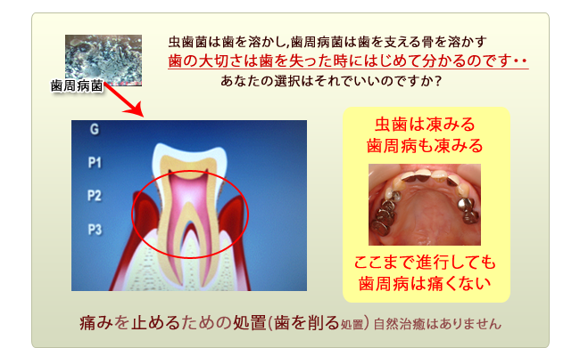 歯周病治療イメージ２