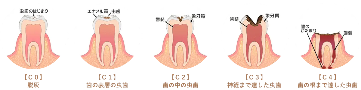 虫歯の進行