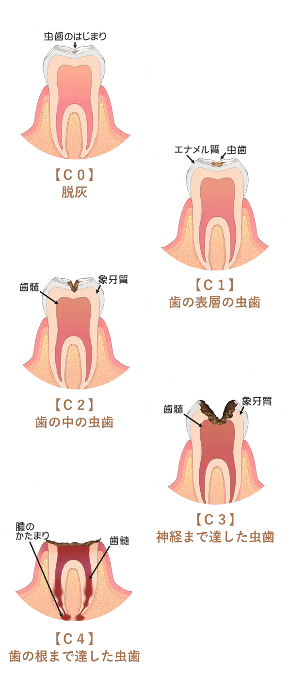 虫歯の進行