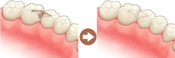 詰め物（インレー、レジン）