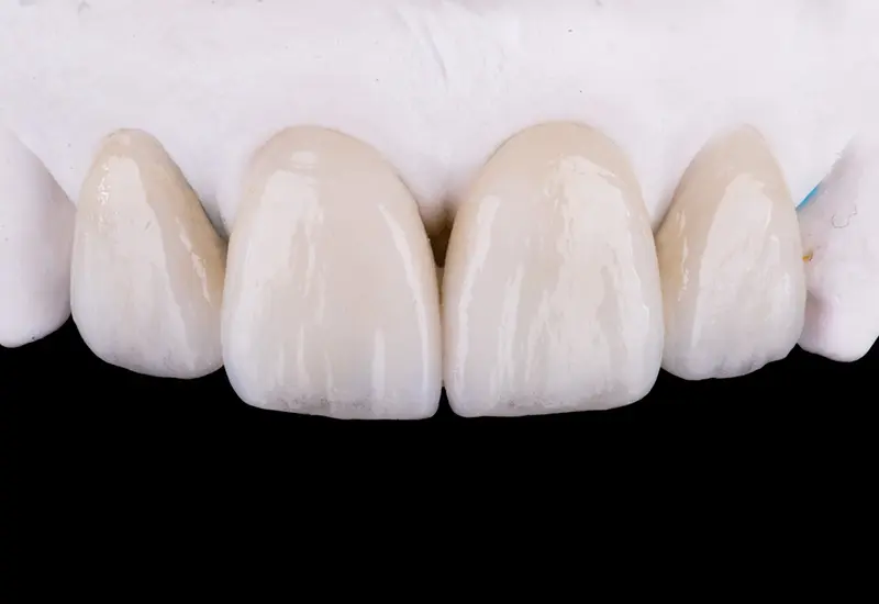 セラミック治療