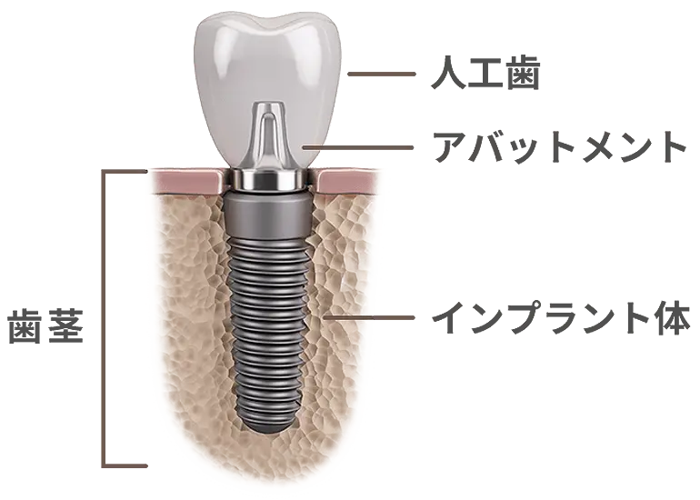 インプラント