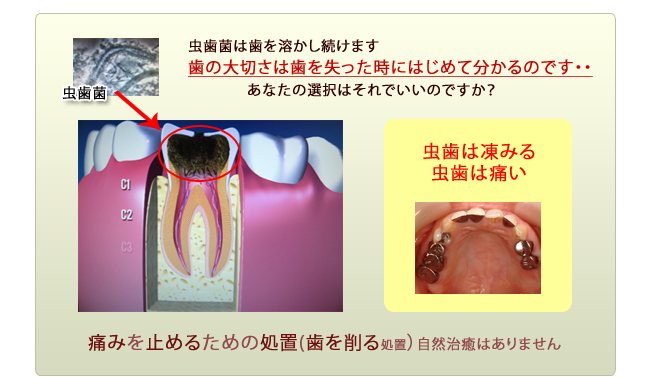 虫歯治療画像２
