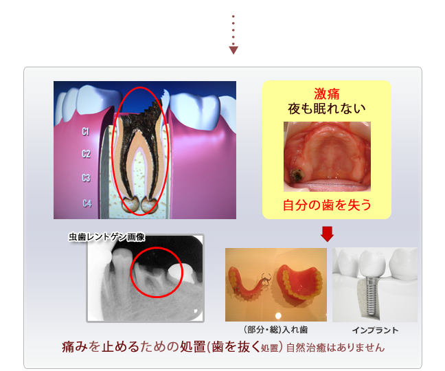 虫歯治療画像３
