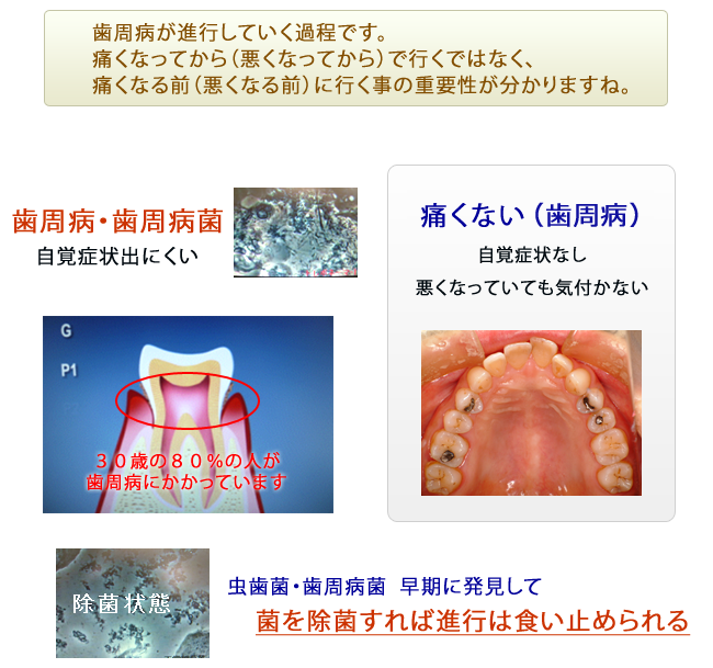 歯周病治療イメージ１