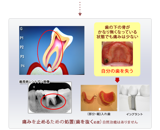 歯周病治療イメージ３