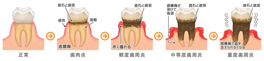歯周病の進行