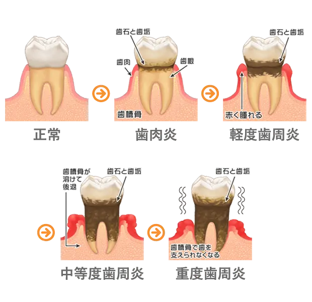 歯周病の進行